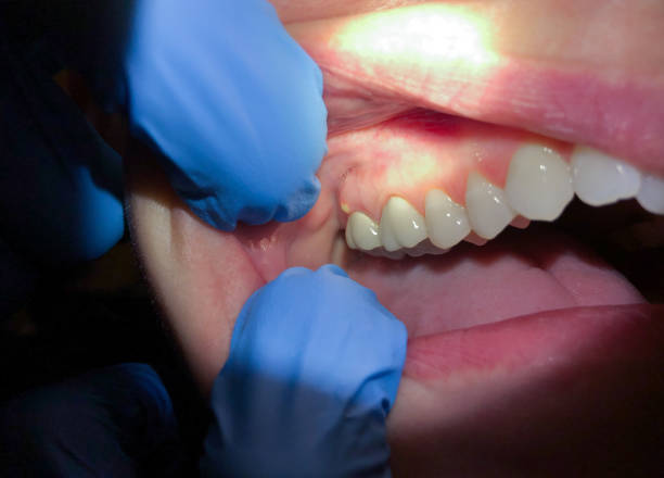 Best Walk-In Emergency Dental Services in Washburn, IL